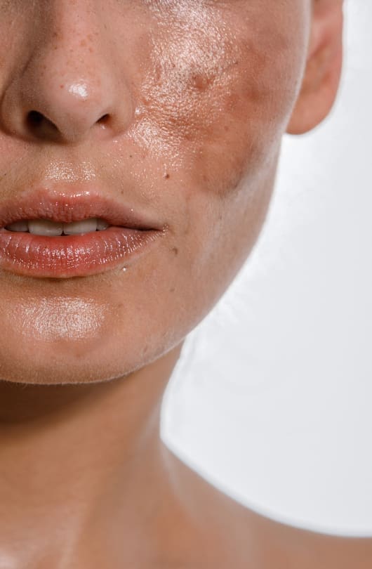 Skin Discolouration Treatment - The Day Clinic