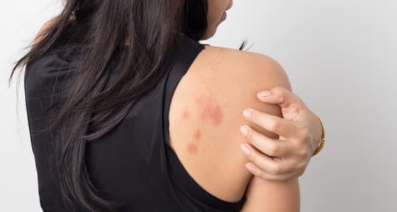 The Day Clinic - Urticaria