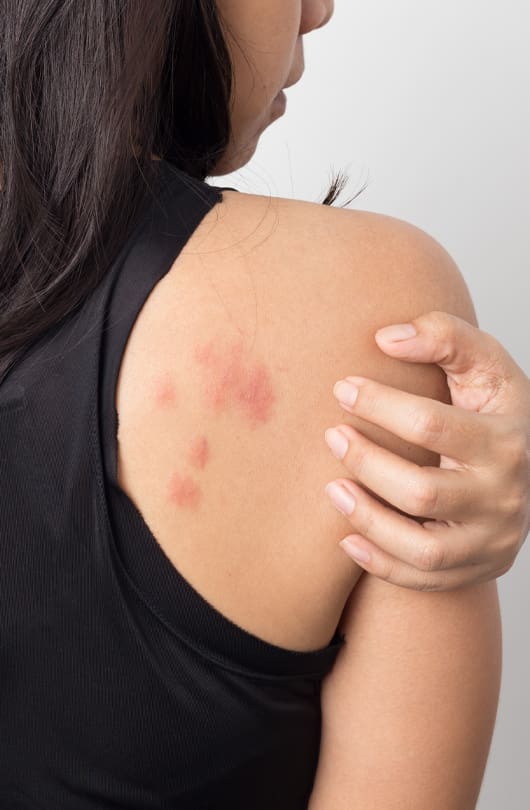 The Day Clinic - Urticaria