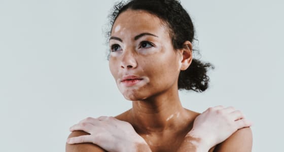 The Day Clinic - Vitiligo