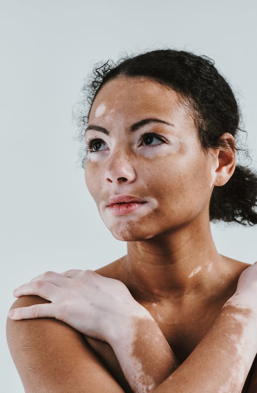 The Day Clinic - Vitiligo