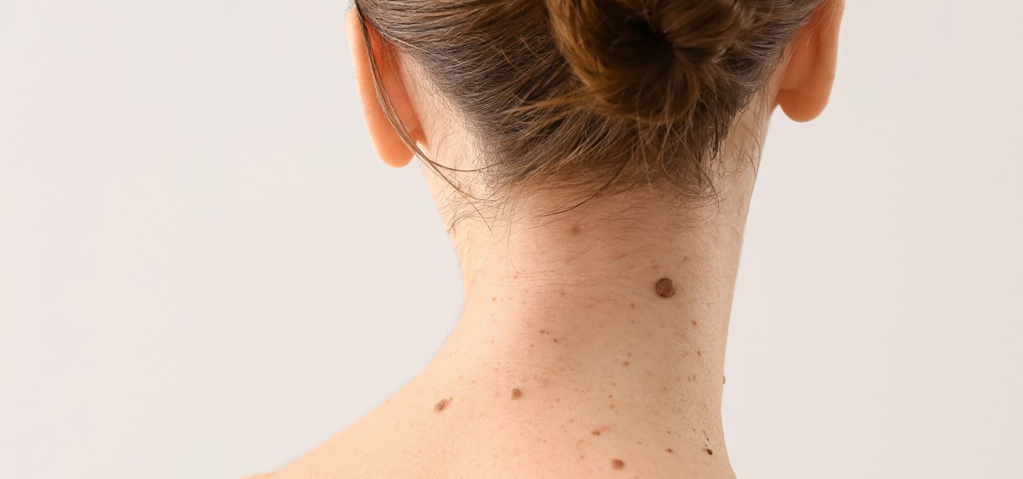 A Girl with moles on a Body
