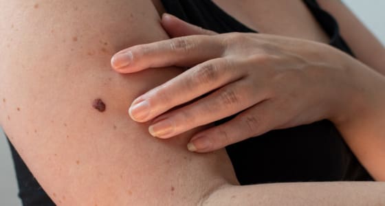 Mole Treatment - The Day Clinic