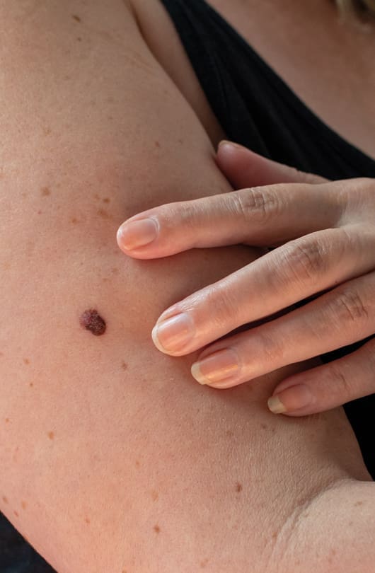 Mole Skin Treatment - The Day Clinic