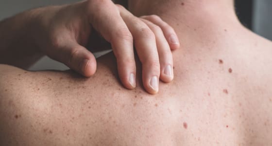 Surgical Excision Treatment - The Day Clinic