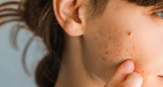 The Day Clinic - Acne