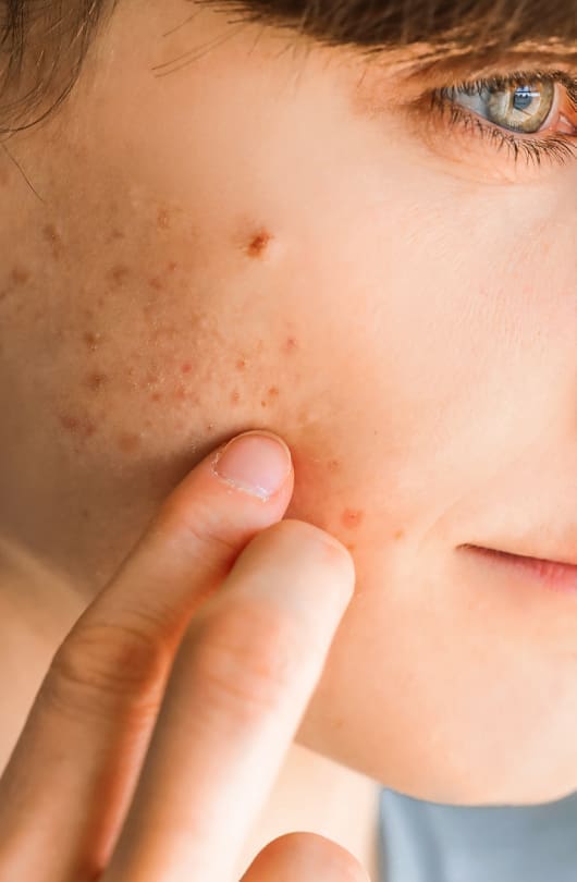The Day Clinic - Acne