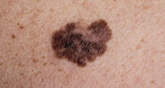 The Day Clinic - Melanoma