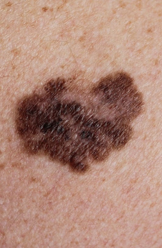 The Day Clinic - Melanoma