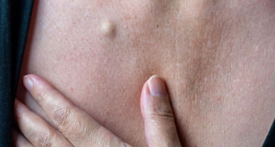 The Day Clinic - Sebaceous Cysts