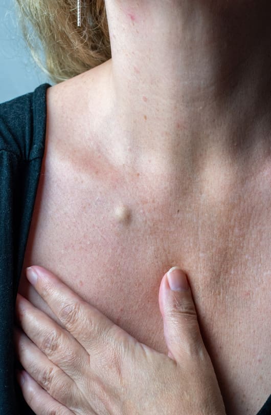 The Day Clinic - Sebaceous Cysts