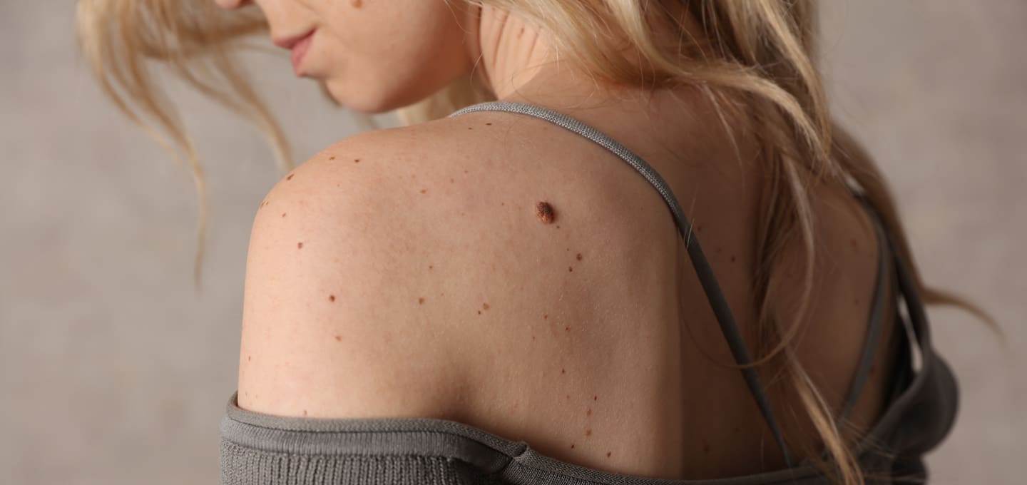 The Day Clinic - Skin Tags
