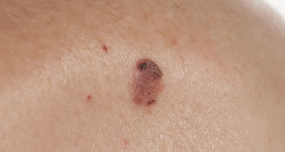 The Day Clinic - Squamous Cell Carcinoma