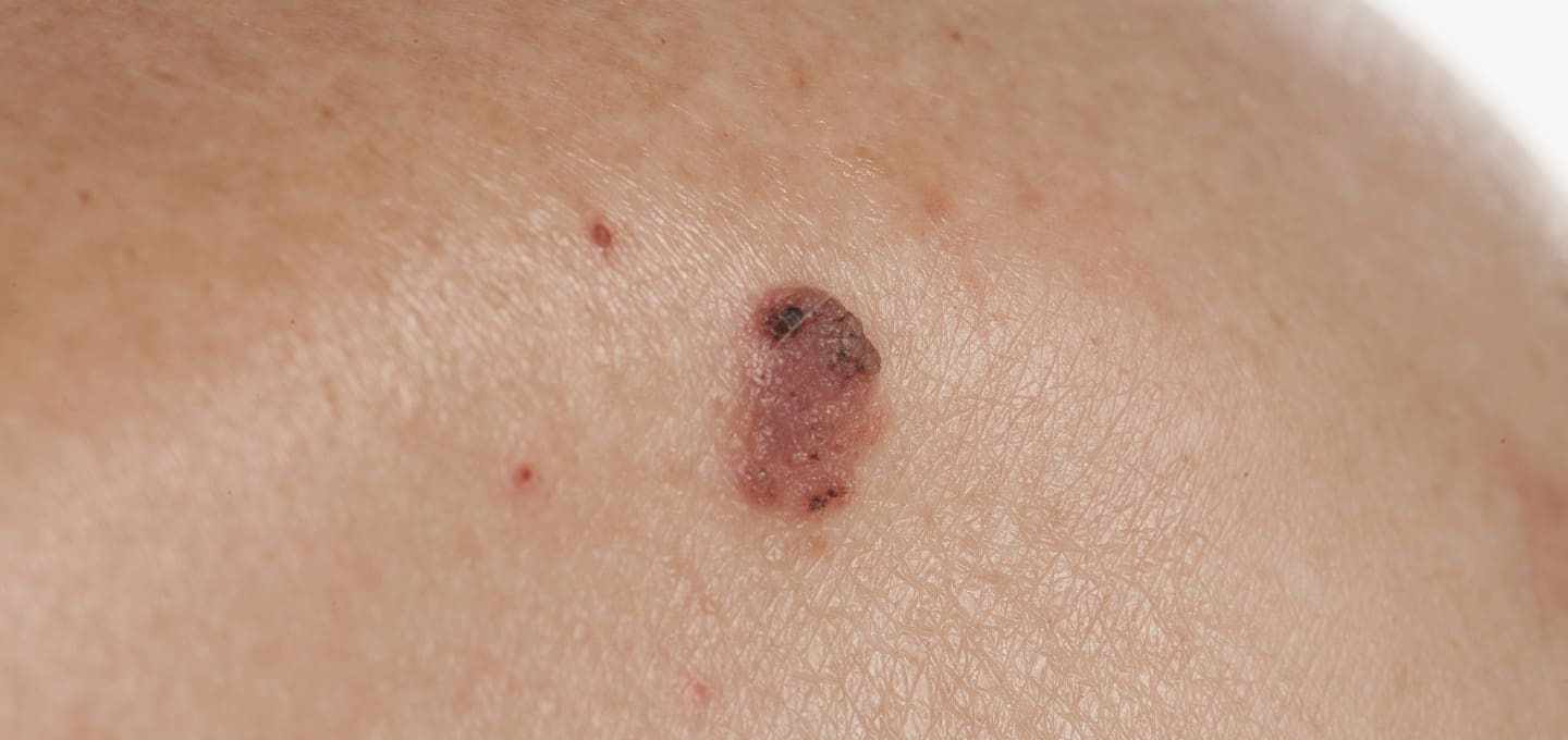 The Day Clinic - Squamous Cell Carcinoma