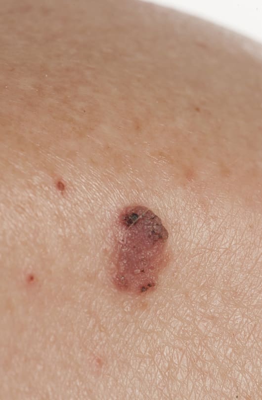 The Day Clinic - Squamous Cell Carcinoma