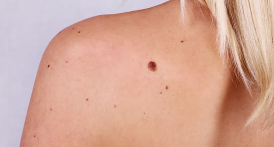 Plastic Surgery Reconstruction After Skin Cancer