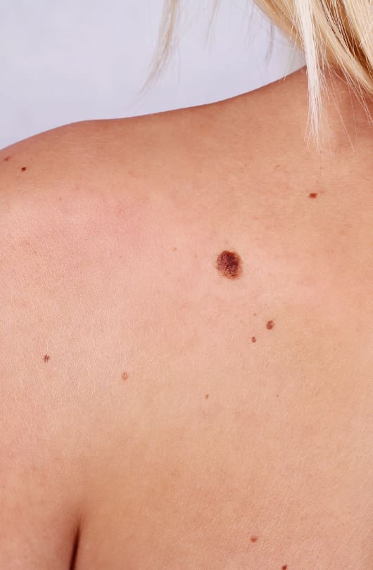 Plastic Surgery Reconstruction After Skin Cancer
