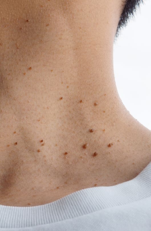 Shave Excision
