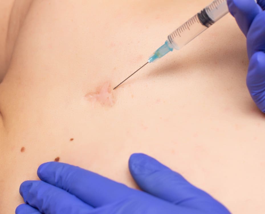 Steroid Injection