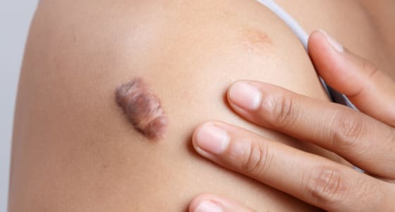 Steroid Injection