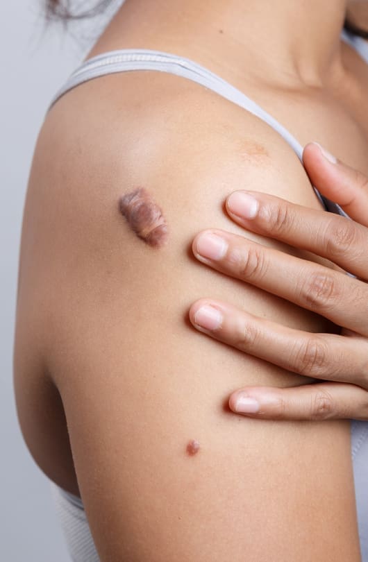 Steroid Injection