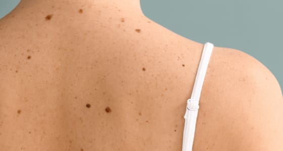 Surgical Excision For Skin Cancer