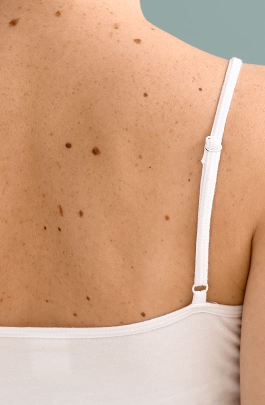 Surgical Excision For Skin Cancer