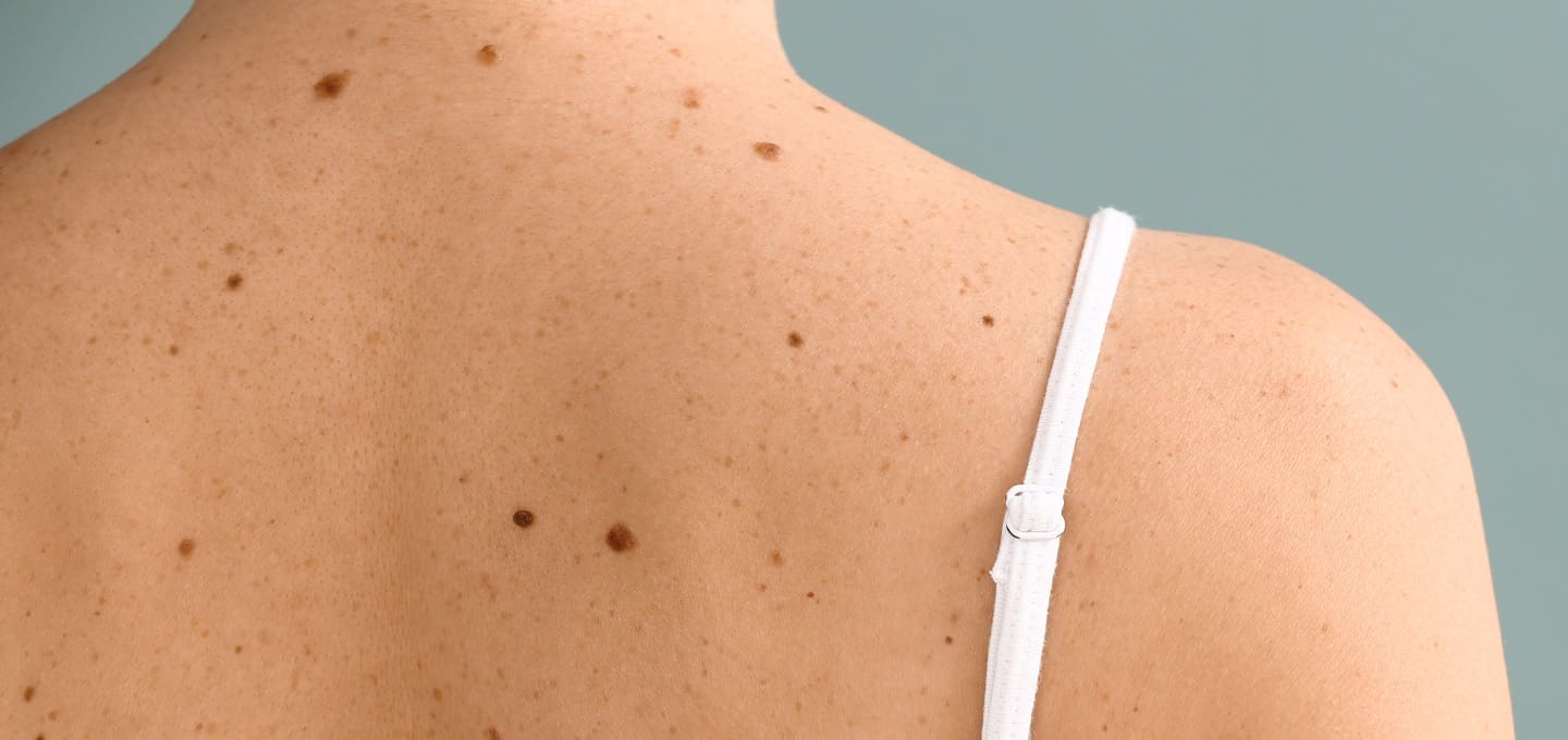 Surgical Excision For Skin Cancer