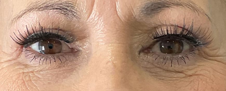 Frontal close-up of patient’s eyes with lifted, smoother upper eyelids after blepharoplasty.