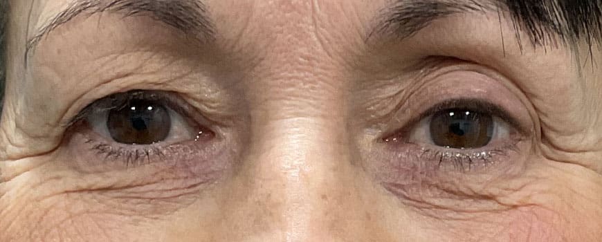 Frontal close-up of patient’s eyes with drooping upper eyelids before blepharoplasty.