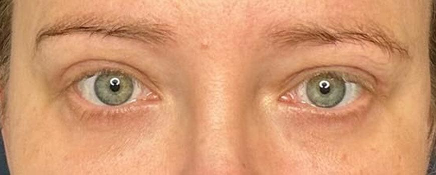 Frontal view of patient’s eyes showing tightened, taut eyelids after blepharoplasty.