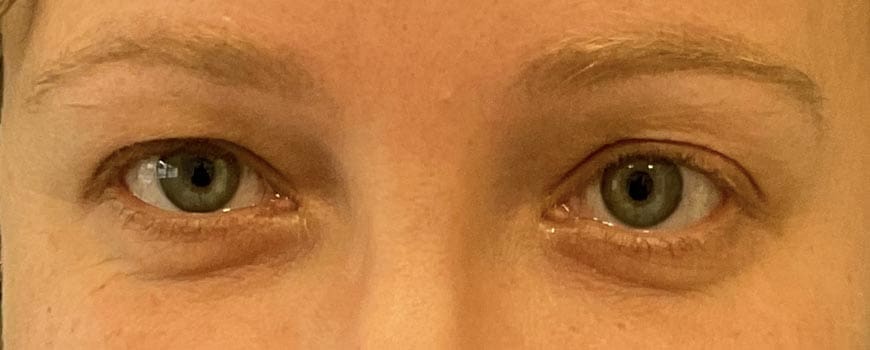 Frontal view of patient’s eyes showing excess bag skin before blepharoplasty.
