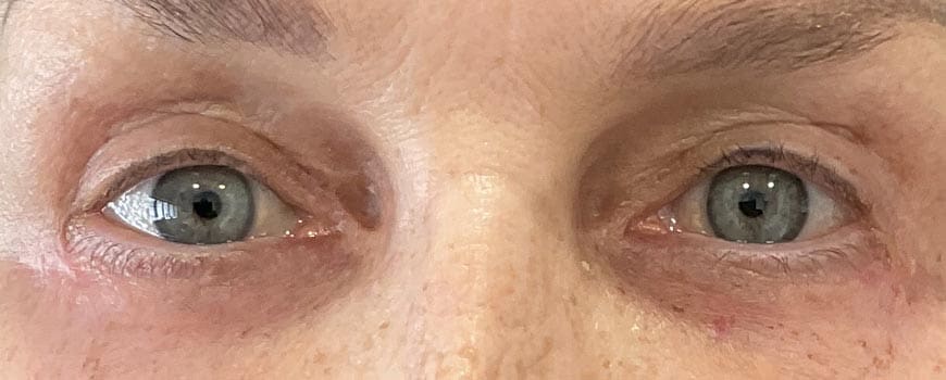 A patient's eyes showing great improvement after blepharoplasty surgery by Dr Abood