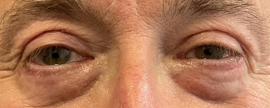 Close-up of patient’s eyes with sagging skin on the upper eyelid before surgery.