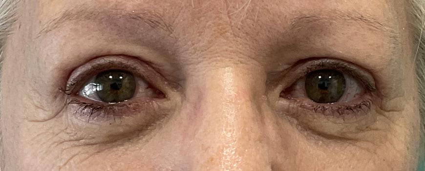 Patient's eyes after Blepharoplasty eye bag removal surgery