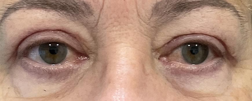 Close-up of patient’s drooping eyelids after upper-eyelid plastic surgery.