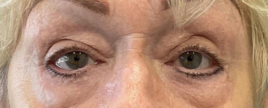 A female blepharoplasty patient showing improvement after surgery