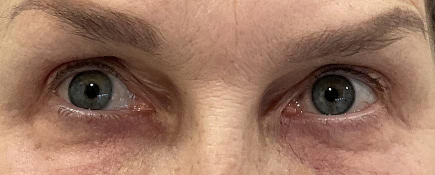 Close-up of patient’s eyes showing reduced upper-eyelid sagging after surgery.