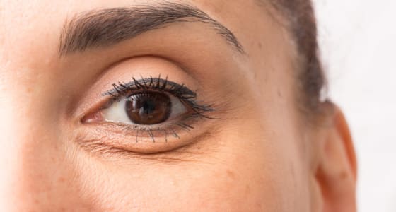 Illustration of eye bags and puffiness - The Day Clinic Cambridge