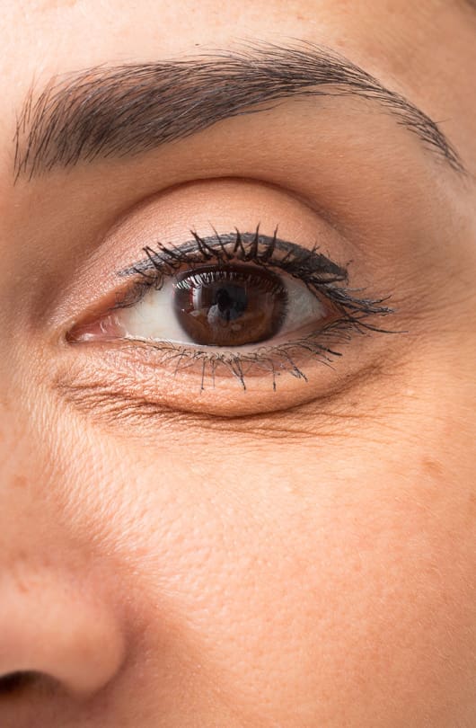 An example of eye bags and eye puffiness - The Day Clinic Cambridge