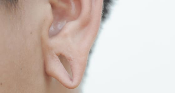 Split Earlobes