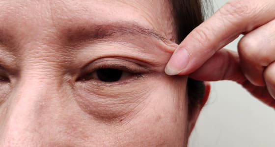Blepharoplasty