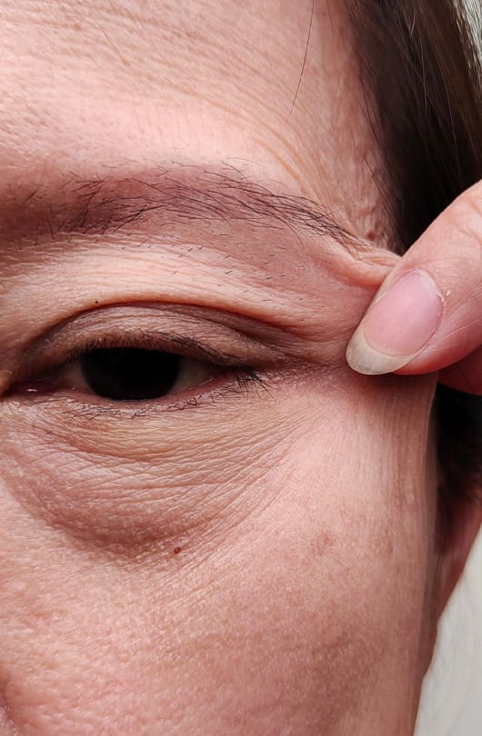 Blepharoplasty