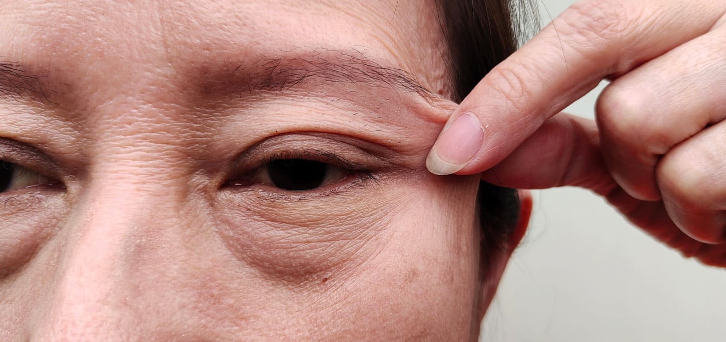 Blepharoplasty