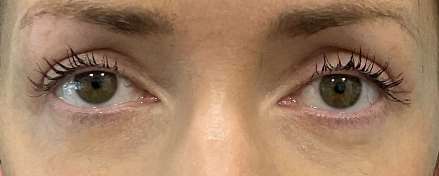 A patient with lifted upper eyelids after blepharoplasty