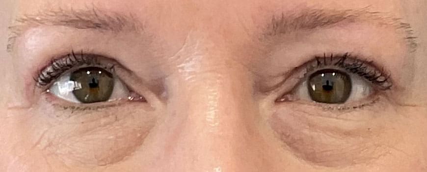 A patient with eye bags removed after blepharoplasty