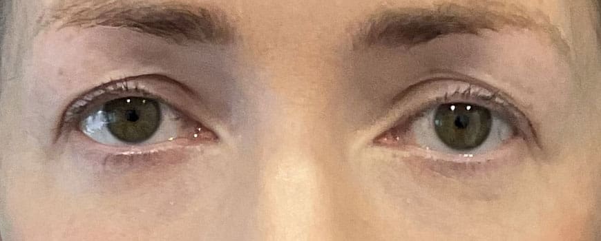 A patient with upper eyelids sagging before blepharoplasty