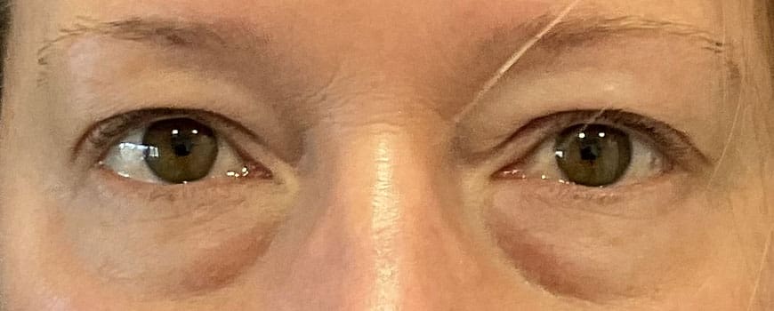 A patient with eye bags before blepharoplasty