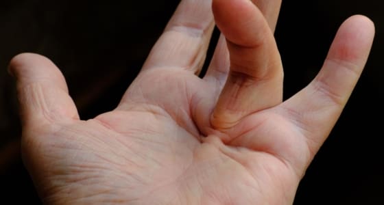 The Day Clinic - Dupuytren’s Contracture