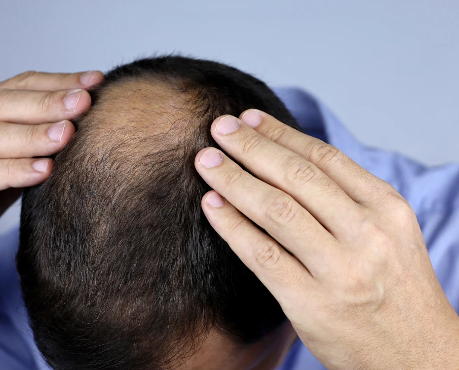 male hair loss Cambridge patient
